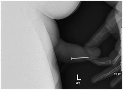 Conservative Management for Urethral Foreign Body: A Case Report of an Adolescent Boy With Repeated Events